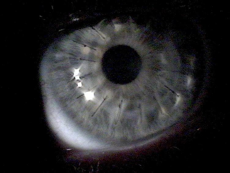 Corneal transplantation - Wikipedia