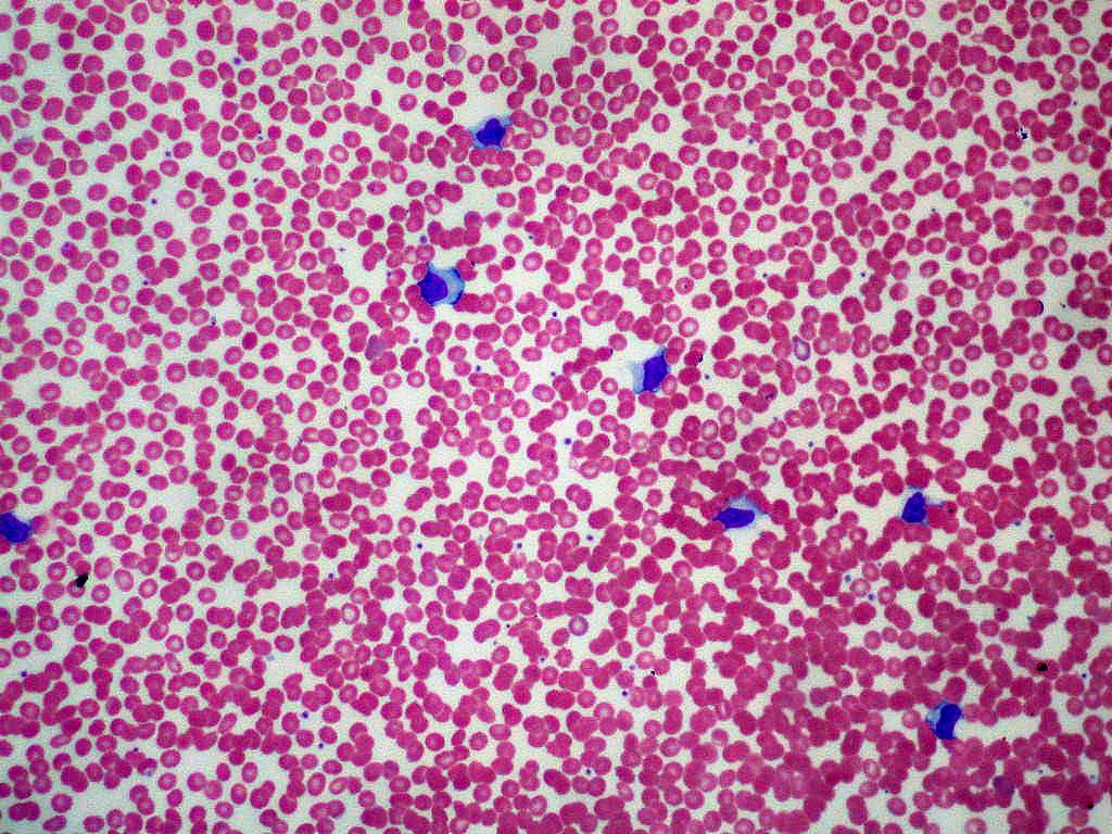 Mononucléose infectieuse — Wikipédia