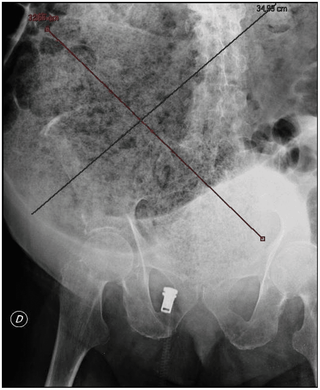 Fecal impaction - Wikipedia