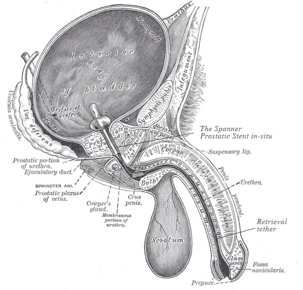 Prostatic stent - Wikipedia