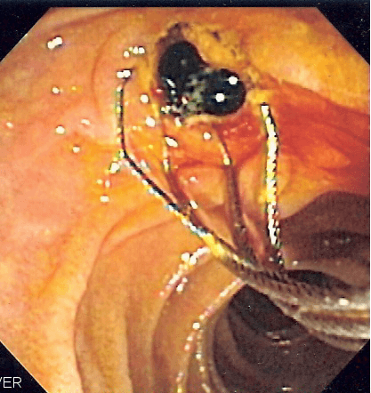 Endoscopic retrograde cholangiopancreatography - Wikipedia