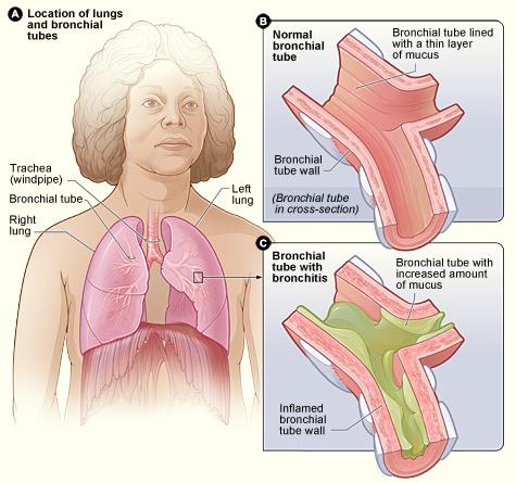 Acute bronchitis - Wikipedia