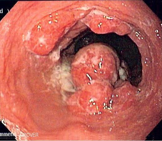 Esophageal cancer - Wikipedia