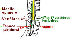 Anesthésie péridurale — Wikipédia