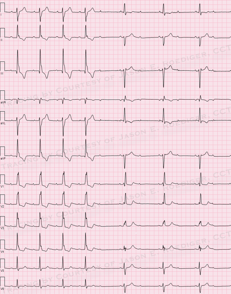 Trifascicular block - Wikipedia