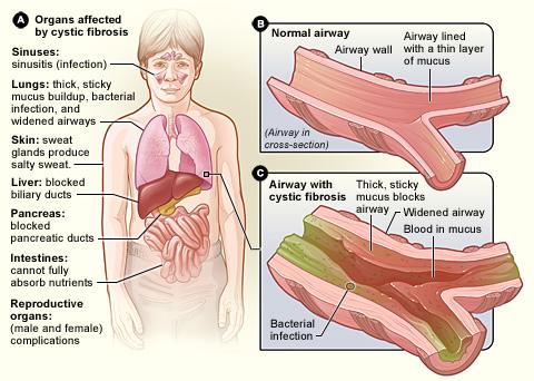 Cystic fibrosis - Wikipedia