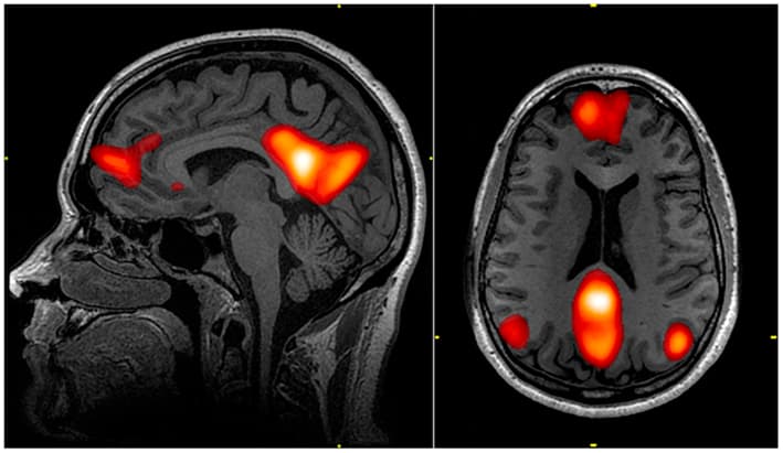 Default mode network - Wikipedia