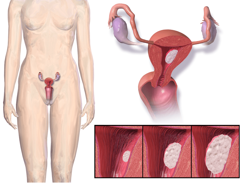 Endometrial cancer - Wikipedia