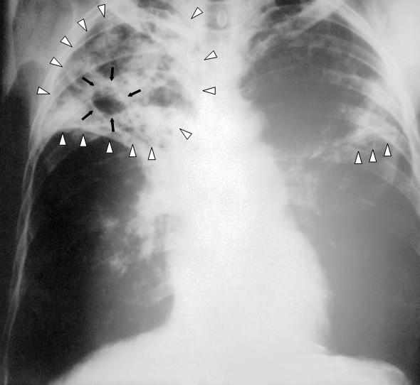 Tuberculosis - Wikipedia