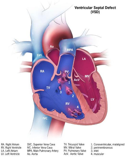 Ventricular septal defect - Wikipedia