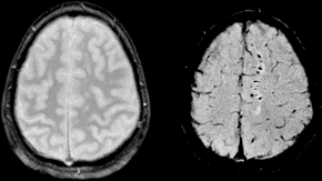 Diffuse axonal injury - Wikipedia