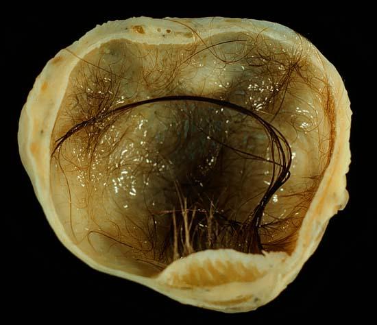 Teratoma - Wikipedia