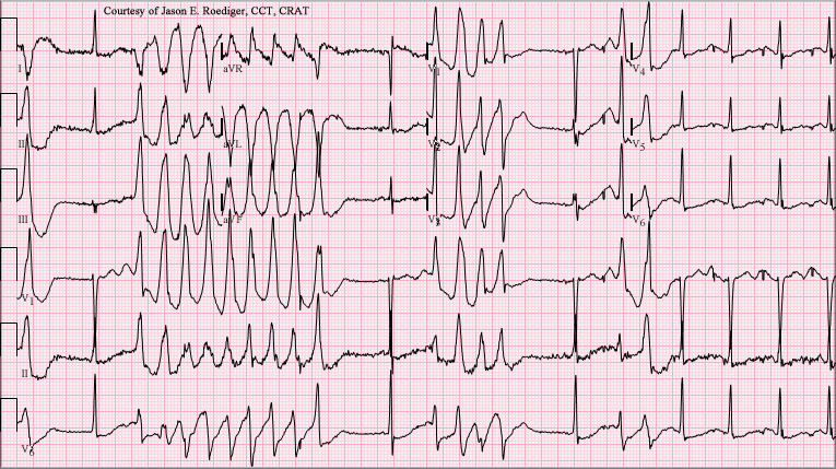 Torsades de pointes - Wikipedia