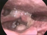 Laryngeal cancer - Wikipedia