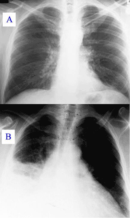 Hospital-acquired pneumonia - Wikipedia