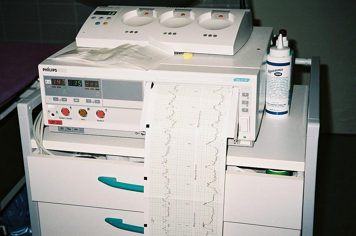 Cardiotocography - Wikipedia