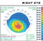 Corneal topography - Wikipedia