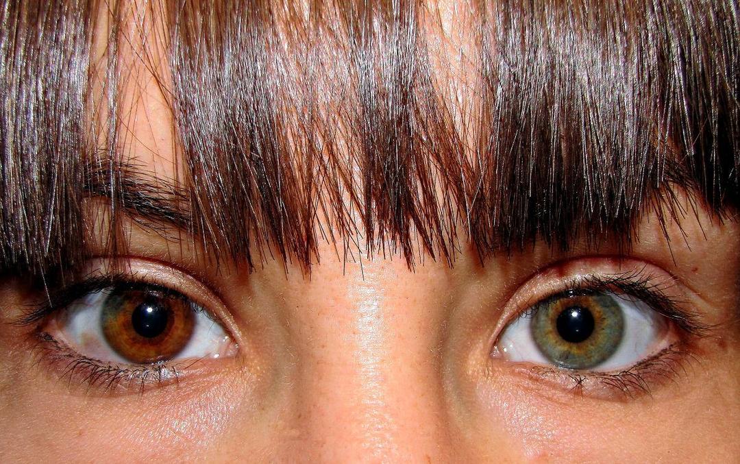 Heterochromia iridum - Wikipedia