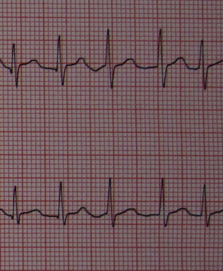 Fibrillation atriale — Wikipédia