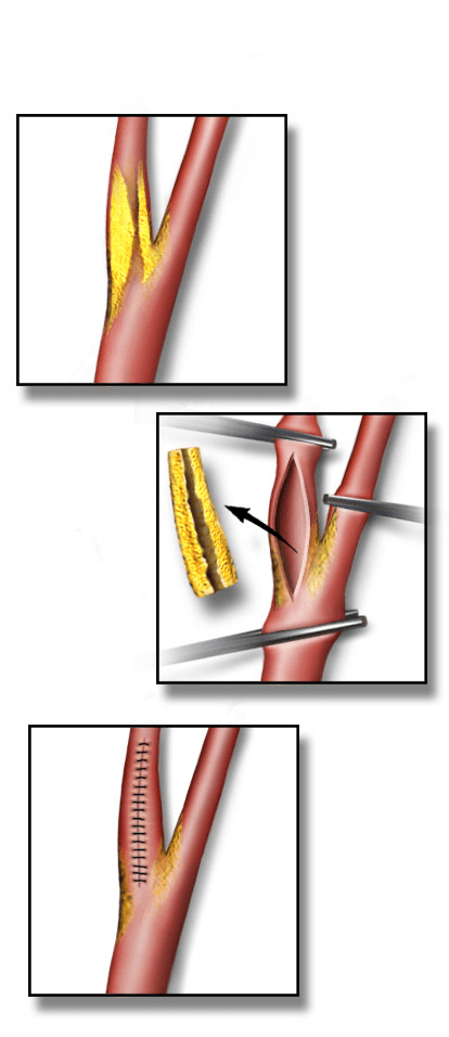 Chirurgie vasculaire — Wikipédia