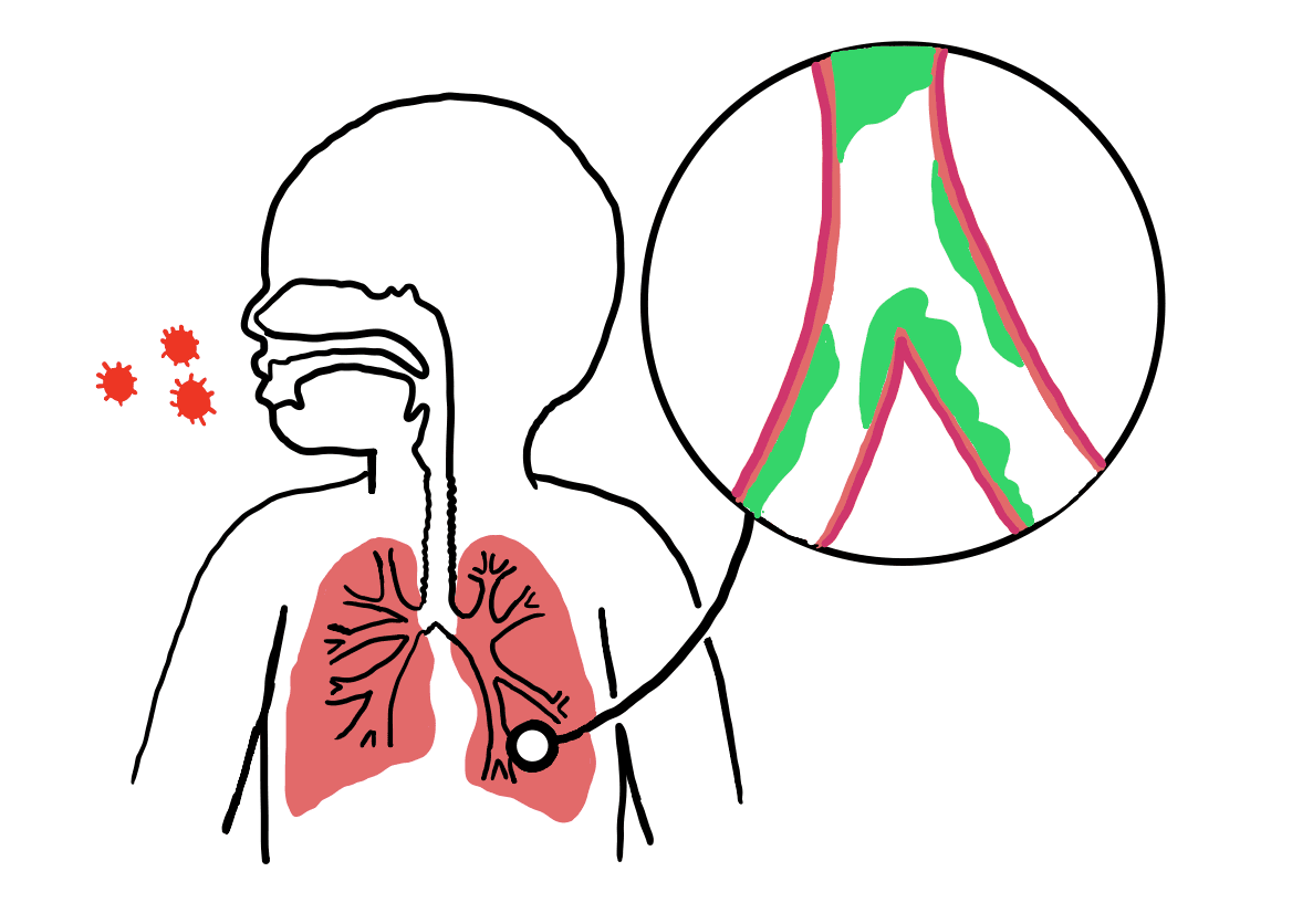 Bronchiolitis - Wikipedia