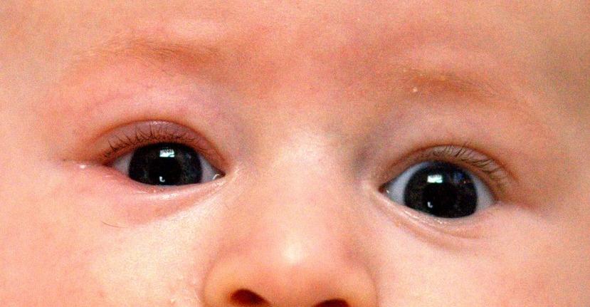 Blepharitis - Wikipedia