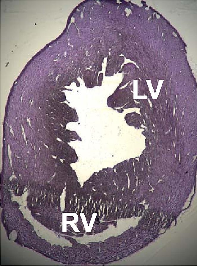 Dilated cardiomyopathy - Wikipedia