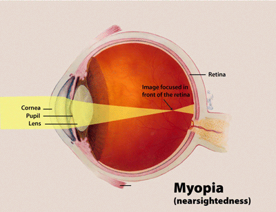 Myopia - Wikipedia