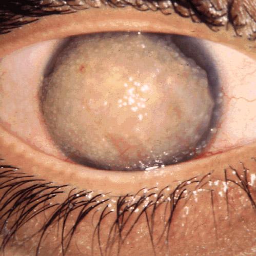 Corneal dystrophy - Wikipedia
