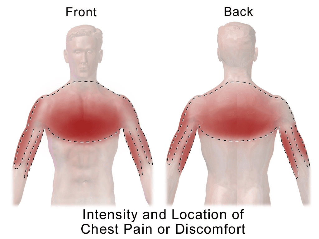 Chest pain - Wikipedia