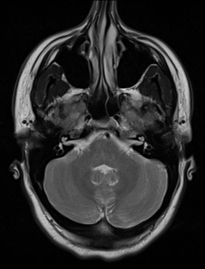 Nasal septum deviation - Wikipedia