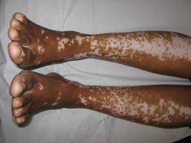 Vitiligo — Wikipédia