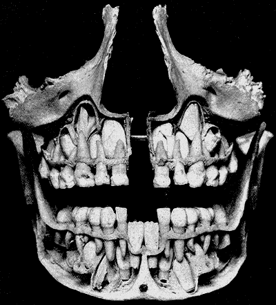 Deciduous teeth - Wikipedia