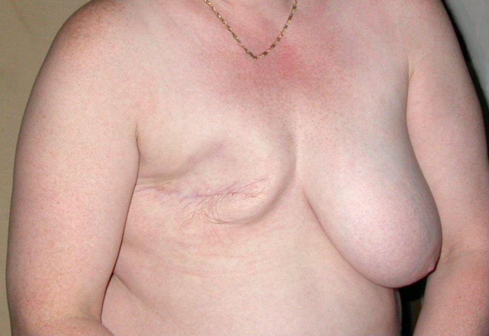 Mastectomy - Wikipedia