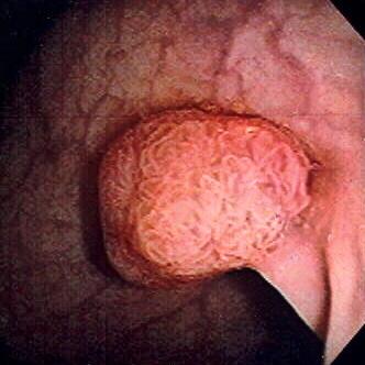 Colorectal polyp - Wikipedia