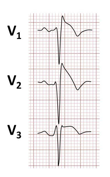 Brugada syndrome - Wikipedia