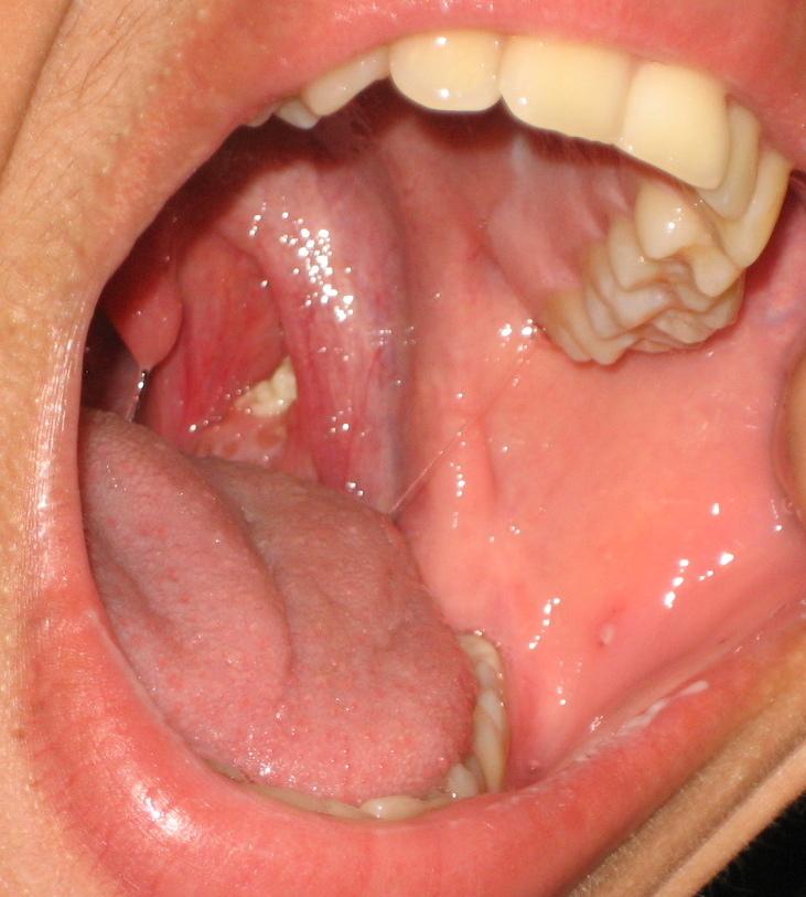 Tonsil stones - Wikipedia