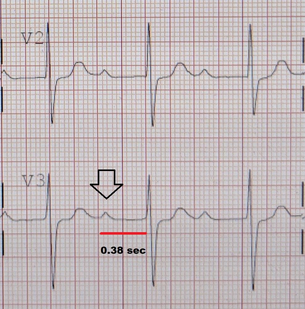 First-degree atrioventricular block - Wikipedia