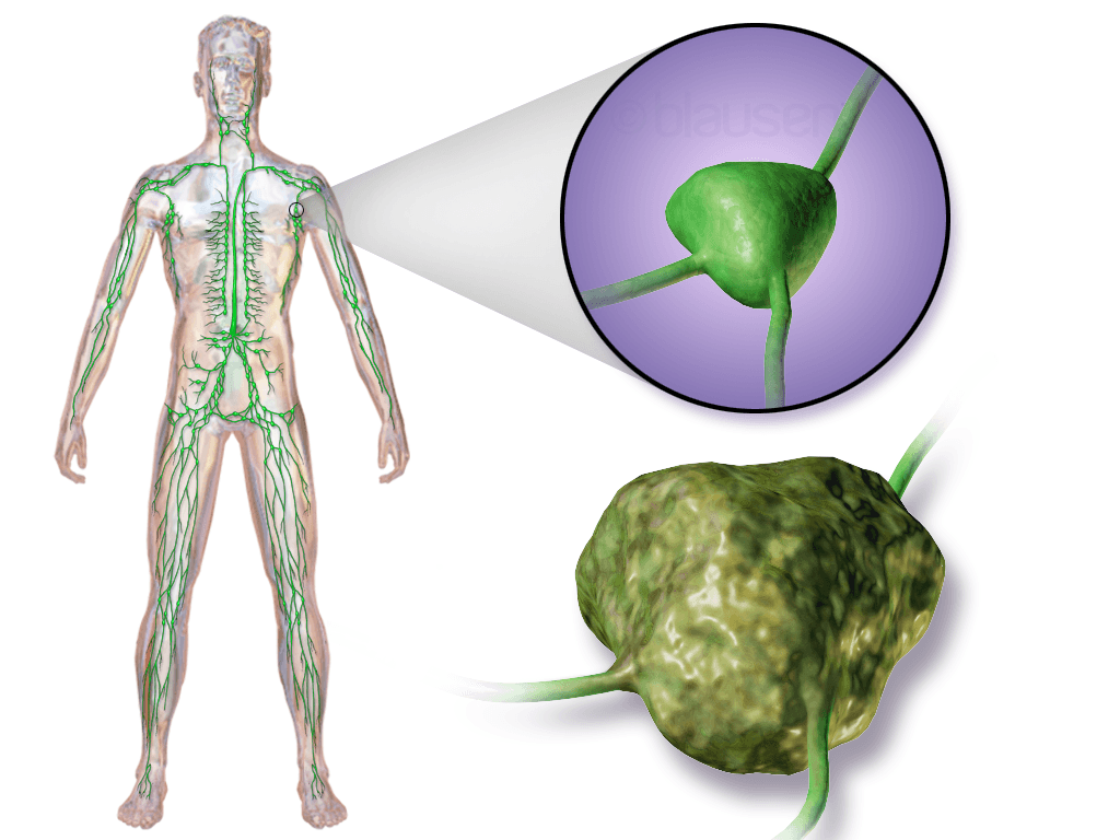 Lymphoma - Wikipedia