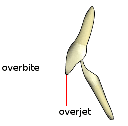 Overjet - Wikipedia