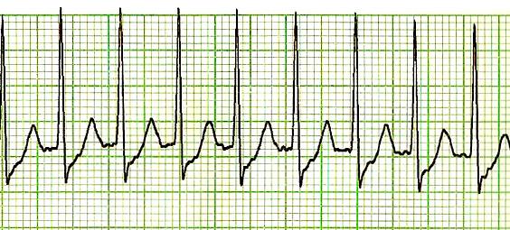 Supraventricular tachycardia - Wikipedia