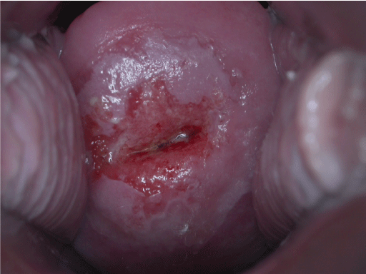 Néoplasie cervicale intra-épithéliale — Wikipédia