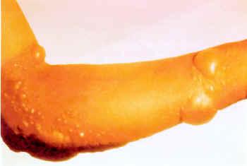 Blister agent - Wikipedia
