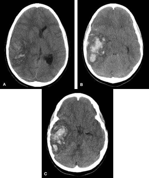 Intraparenchymal hemorrhage - Wikipedia