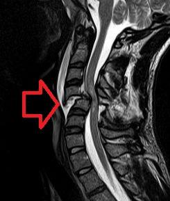 Spinal cord injury - Wikipedia