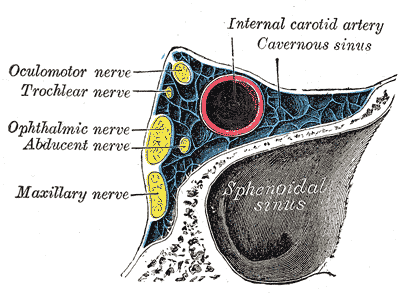 Cavernous sinus thrombosis - Wikipedia