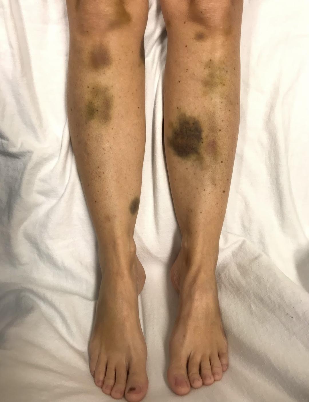 Purpura thrombotique thrombocytopénique — Wikipédia