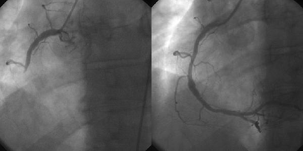 Interventional cardiology - Wikipedia