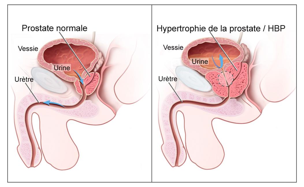 Hypertrophie bénigne de la prostate — Wikipédia