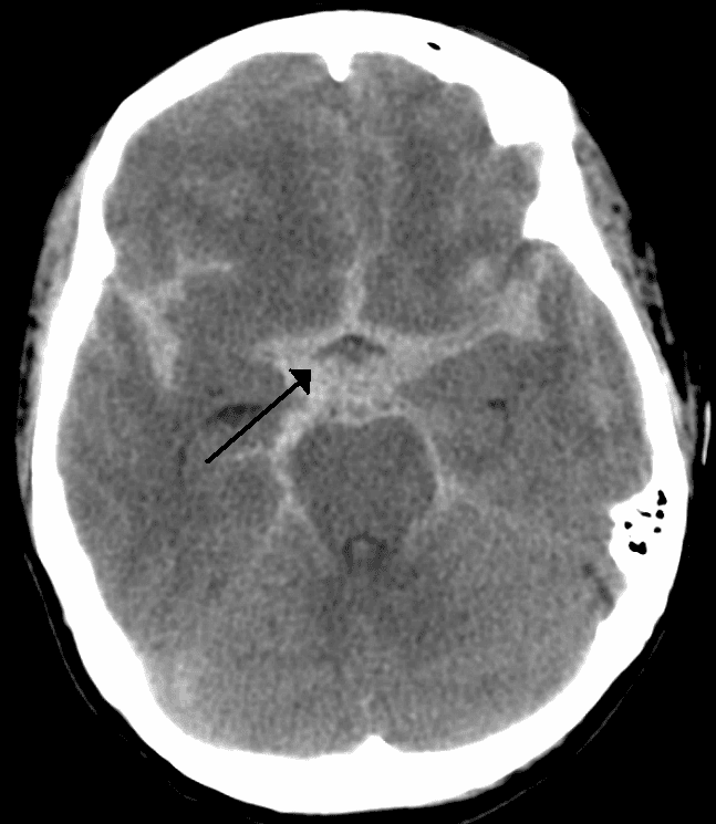 Subarachnoid hemorrhage - Wikipedia